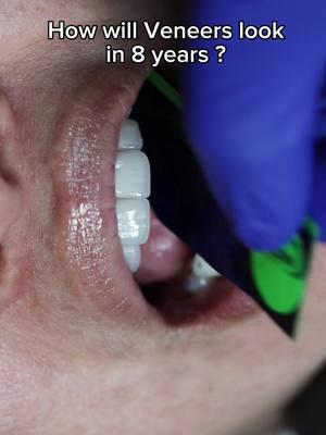 How will Veneers look in a couple of years?🤔🦷 With proper care and good oral hygiene, they can look as good as new for 15-20yrs! #veneercare #oralhealth #oralhygiene #dentalveneers #veneers #naturalveneers #porcelainveneers #veneer #dentalhygiene 