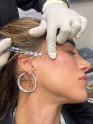 0.5 cc. of Restylane Defyne  with the cannula technique was used on each side to subtly enhance her cheek contours, providing a more sculpted and lifted effect. #cheekfiller #injector #filler