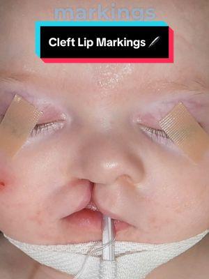 Hi 👋🏼 everyone!  It’s #markingsmonday!! 🖊️🖊️ Today I’m highlighting the intra-op markings of a recent RIGHT unilateral  COMPLETE cleft lip 👄 and nasal 👃🏼 reconstruction.  It is important to keep in mind that EVERY cleft patient has unique anatomy. Therefore my markings 🖊️ for each repair are different in each case, which ultimately leads to  a unique surgery each and every time. 👍🏻 Stay tuned for updates on this baby’s progress! I hope this video was helpful! As always, leave your questions and comments below. 👇🏼 Goal: To help make children WITH clefts look like children WITHOUT clefts. 😄 Mission: Transforming children’s lives one smile at a time. 👍🏼 These images are the property of Dr. Rachel A. Ruotolo and NYPSG and are not authorized for use by any other party. This is my actual patient with real results who has given informed consent (directly or indirectly via parents) to appear on my website and social media pages. #makingsmiles #cleftliprepair #cleftpalate #cleftlip #cleft