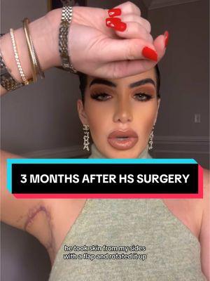 Morgan shows us her incisions 3 months after HS surgery! #tiktok #LearnOnTikTok #viral #viralvideo #doctorsoftiktok #hidradenitissuppurativa #hidradenitissuppurativawarrior #hidradenitissuppurativaawareness #hs #skindisease #skincondition #doctors #surgeonsoftiktok #patient #fyp