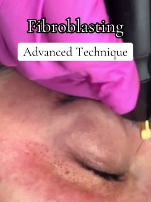 Can you see it ?!?   Advanced techniques in #fibroblast can consist of 2 passes. . This technique should only be done by professionals . Looking to train dm for more info  #facialtreatment #estheticianlife #nonsurgical #plasmapentreatment #plasmapen 