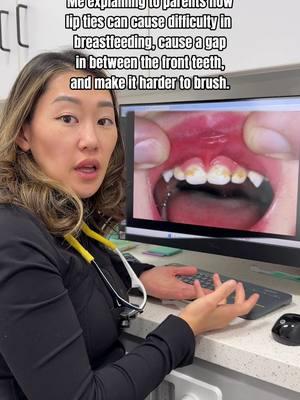 Lip tie is when this tissue (called a frenulum) that connects the lip to the gum is restrictive due to it being short, tight, or thick. It can affect many things: breastfeeding challenges, teeth spacing, and become an area of food trap. However, I want parents to know that not all frenulums need a lip tie procedure. It is a NORMAL part of the body and especially in infancy, it can appear more prominent and low. The evaluation of whether to have the lip tie procedure in infancy must be functionally assessed by a trained provider. Lip ties also do NOT cause cavities though it can make it more difficult for optimal toothbrushing. It's important to note that they are correlated but lip ties do NOT cause cavities. Do lip ties cause speech issues? Generally speaking, no. However, lip ties are on a spectrum and pediatric dentists are trained to evaluate whether this procedure (Frenectomy) is beneficial for the child. Have you heard of lip-tie or tongue-tie before? #pediatricdentist #pediatricdentistry #liptie #tonguetie #dentisttok 