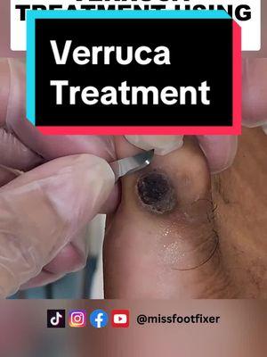 Wart or Verruca treatment Using swift and acid by Miss Foot Fixer Marion Yau, #missfootfixer #footwart #verruca #verrucatreatment 