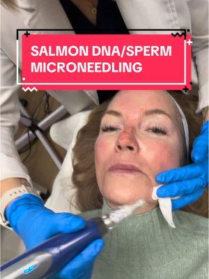 ✨ Menopause skin? ✨ I’m trying the Korean beauty secret that’s a game-changer for aging skin: Salmon DNA/Sperm Microneedling 🐟💉 Perfect for restoring that youthful glow as we age. Stay tuned for day 2 🌟 Boosts collagen for plumper, firmer skin 🌟 Repairs and hydrates dryness from hormonal changes 🌟 Smooths fine lines, wrinkles & improves elasticity 🌟 Leaves skin radiant and rejuvenated Who else is ready to glow through menopause? #MenopauseSkinCare #AntiAgingGlow #SalmonDNATreatment #KBeautySecrets  #SkinCareOver50 #HormonalSkinHelp #GlassSkinGoals