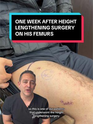 One week after he underwent Height Lengthening to get taller #tiktok #LearnOnTikTok #viral #taller #tall #tiktok #shortpeopleproblems #shortking #shortman #height #heightproblems #heightdifference #tallman #surgeons #surgeonsoftiktok #doctorsoftiktok #doctor #heightlengthening #limblengthening #doctors 