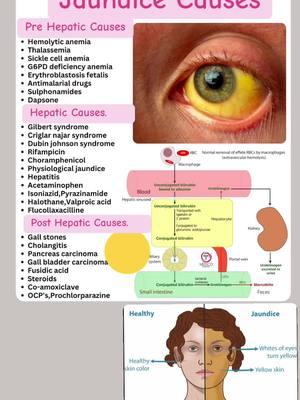 Pre-Hepatic Causes: • Hemolytic anemia • Thalassemia • Sickle cell anemia • G6PD deficiency anemia • Erythroblastosis fetalis • Antimalarial drugs • Sulphonamides • Dapsone Hepatic Causes: • Gilbert syndrome • Criglar najar syndrome • Dubin johnson syndrome • Rifampicin • Choramphenicol • Physiological jaundice • Hepatitis • Acetaminophen • Isoniazid,Pyrazinamide • Halothane, Valproic acid • Flucollaxacilline Post-Hepatic Causes: • Gall stones • Cholangitis • Pancreas carcinoma • Gall bladder carcinoma • Fusidic acid • Steroids • Co-amoxiclave • OCP's,Prochlorparazine #nursingnotes #internationalnurses #nepalinurse🇺🇸 #nursingstudent #indiannurses #liverhealth 