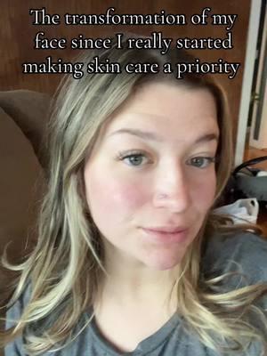 Super vulnerable post here… sharing something I’ve been insecure about for 10+ years: my acne. For the first time, my skin is glowing, and I feel confident without foundation. I used to hide under makeup, but now I feel free. All the research and finding the right products was worth it. Excited to keep this skincare journey going and see even more progress!🧖🏼‍♀️🧴#skincare #acne #insecure #cysticacne #panoxyl #ordinaryskincare #dermatologist #skincareproducts #cerave #snailmucinskincare #musthaveproducts #clearskin #glowingskin #skincaretransformation #vulnerable 