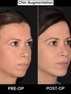 TRANSFORMATION TUESDAY 🔥 🔥 Our beautiful patient came to us wanting more chin projection. After undergoing a chin augmentation, she now has a better jawline and a perfectly balanced profile. Have questions? Drop them below! ⬇️  #chinaugmentataion #augmentation #jawline #goals #jawcontouring #jawlinegoals #fyp #DrRahban #beforeandafter #transformation #plasticsurgery #plasticsurgeon #beautytips #results #losangeles 