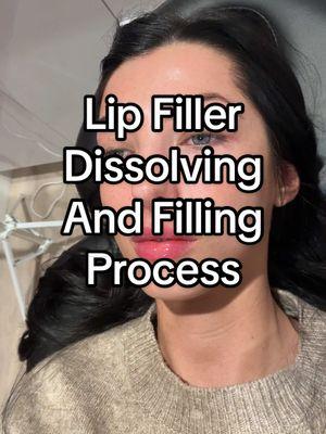 A video of my lip filler dissolving and refilling process! Ask if you have any questions ☺️ #creatorsearchinsights #lipfiller #fillerdissolving #lipfillermigration #lipfillerprocess 