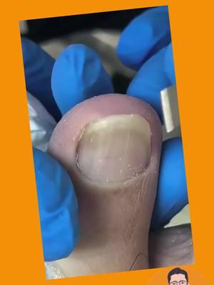 #nails #toenail #toenailremoval #ingrowntoenail #satisfyingvideo #foryourpage #oddlysatisfying 