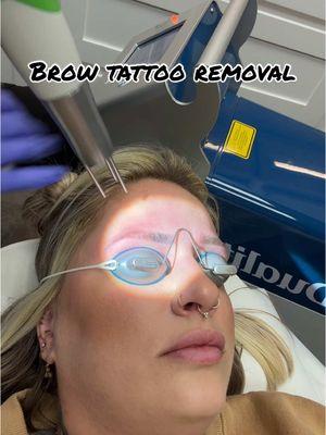 A journey it’s been😄 #browtattoo #browtattooremoval #tattooremoval #zap #tattoo #microblading #powderbrows #browtattoo 