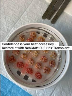 Confidence is your best accessory 💯✨ Restore it with NeoGraft FUE Hair Transplant—the gold standard for hair restoration! Here’s how it works: 1️⃣ Prep the donor site at the back of the head. 2️⃣ Numb the area with local anesthesia for comfort. 3️⃣ Harvest grafts using the advanced, scar-free FUE method. 4️⃣ Group and prep follicles for the transplant site. 5️⃣ Implant follicles along the hairline for natural density & volume. ✨ Why NeoGraft is the best: •No visible scarring 🚫✂️ •Minimally invasive for faster recovery ⏱️ •Natural-looking, permanent results 🌟 •Ideal for restoring density in areas where follicles no longer grow! Take control of hair loss and get back to looking (and feeling) your absolute best!💪 📞: 404-963-0871 📧: info@kalos-plasticsurgery.com 📍: 371 E Paces Ferry Rd NE Ste 850 Atlanta, GA 30305 • • • • • • • • #neograft #HairRestoration #HairTransplant #FUEHairTransplant #HairLossSolution #HairGoals #ConfidenceRestored #NaturalHairline #HairTransformation #ThickerHairJourney #HairDensity #HairRestorationExpert #NonSurgicalHairRestoration #NoMoreHairLoss #drbenstong  #kalosplasticsurgery  #ksthetics  #facialplasticsurgery  #atlanta  #buckhead 