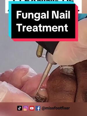 CLEANING OF A FUNGAL NAIL #toenailremoval #missfootfixer #toenailfungus #toenailfungustreatment 