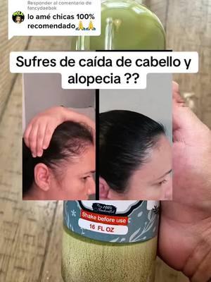 #caidadepelo#caidadecabello#alopecia#romero#dguilleusa 