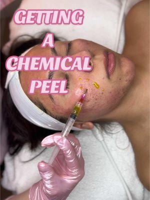 Getting a chemical peel doesn’t have to be scary 🧖🏻‍♀️🪄🍌☁️ Booking in Bio! 🪄 #chemicalpeel #chemicalpeelresults #chemicalpeeljourney #fyp #soloesthetician #esthetician #biorepeel #skincare #skincaretips #foryou #inlandempireesthetician #estheticiantiktok #fypシ゚viral #redlandsfacials #redlandsesthetician #inlandempirefacials 