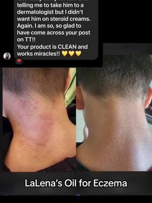 #repost LaLena’s Oil helping to treat Eczema! | LaLena’s Oil by The Wooden Gypsy | #thewoodengypsy #lalenasoil #SmallBusiness #familybusiness #allnatural #bodyoil #eczema #eczemaawareness #eczematok 