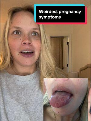 Never had this one before 😅😅 #pregnancy #pregnancysymptom #geographicaltongue #fyp #foryoupage #fypシ #viral