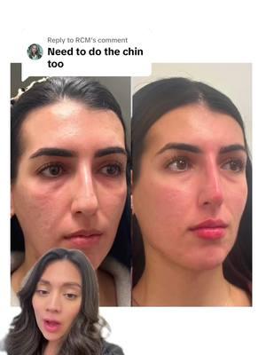 Replying to @RCM #greenscreen explanation to chin filler. When to add more and when no more can be added #chinfiller #jawlinefiller #injector 