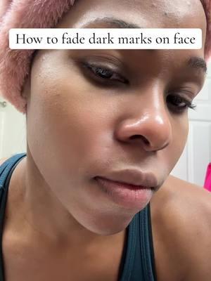 Trentinoin and faded for the win #acne#darkspotsonface #skincare#skinrenewal #skincarejourney #creatorsearchinsights 