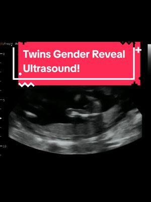 Two Girls? Two Boys? One of Each? What's your guess? #heybabymobile #rochesternyultrasound #2dultrasound #pregnancy #girlorboy #boyorgirl #twinsies #twins #genderreveal #genderrevealultrasound #15weekspregnantwithtwins  www.HeyBabyMobile.com