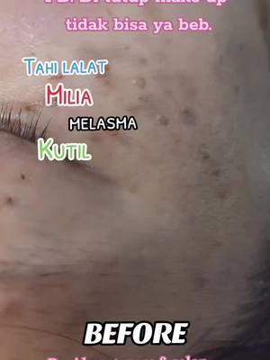 #padahariini #kutil #bintikhitam #bintikhitamwajah #milea #miliaremoval #miliaremovaltreatment #promo #perawatankecantikan #devi_beautycare_salon #devibeautycare_123 #perawatankecantikanhongkong #hongkong #viral #fyppppppppppppppppppppppp #fyp 