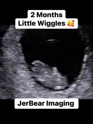 Cute little first trimester wiggles 🥰 #jerbearimaging #baby #9weekspregnant #wiggle #fyp #firsttrimesterpregnancy #peaceofmind #peaceofmindmatters #momlife #growingbaby #pregnant #motherhood #browncounty www.jerbearimaging.com