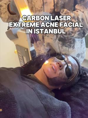 🔥carbon laser facial for EXTREME acne. I got my facial and carbon laser peel from @catwalkbeautystudio (tagged on instagram) in Istanbul, Turkey! This facial was a long process of healing but my god this is what has finally helped my skin! It feels good to not feel ugly (i know im not) but god this is what i needed for all this hormonal acne to calm down.  Patience has literally been key, but feeling so much happier 3 months later too 😩😩😩 . . . . #acne #acnetreatment #acneproneskin #acnescars #darkspots #hyperpigmentation #carbonlaser #carbonlaserpeel #catwalkbeautystudio #hormonalacnejourney #acnetok #skincare #skincareroutine #skincaretiktok #beauty #BeautyTok #wellnessjourney #skincarereview #skincareproducts #facialtreatment #browngirlproblems #browngirlskincare #browngirl 