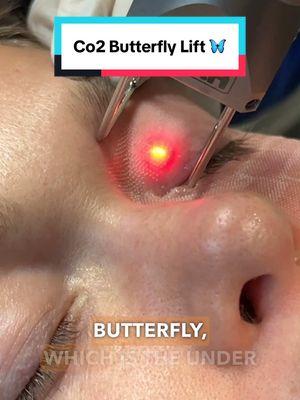 🦋Butterfly Lift CO2 Laser Treats: ☑️Fine lines and wrinkles ☑️Uneven skin tone ☑️Skin texture ☑️Uneven Scars 💡CO2 laser is safe for skin types 1-3 💡Downtime: 7-10 days 💡Can be repeated once a year as part of routine maintenance 💡Please consult with a professional before undergoing CO2 laser. #co2laser #kamiparsamd #finelines #wrinkles #skin #skincare #skintips #skincareroutine 