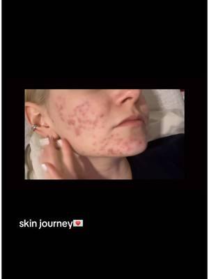 sorry for the dramatic music i tried to put on read but it did not let me…anyways.  hi friends i wanted to share my skin journey because in 2024 while recording the album I was dealing with my acne! i wanted to share this because if anyone else is struggling i hope this can help you not feel as alone. social media is so fake and its okay to not have perfect skin!  #acne #acnetreatment #acneskin #accutanejourney #accutanecheck #accutaneresults #fyp #foryoupage #samithompson #officialsamithompson #skinjourney 