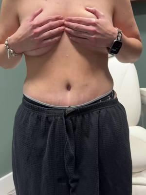 Worried about looking “fake” after a tummy tuck? Have you heard of a tummy tuck done the Willis Way? The magic is in the belly buttons ✨😍 #stlouis #tummytuck #weightloss #bellybutton #drwillis #tuck #mommymakeover 