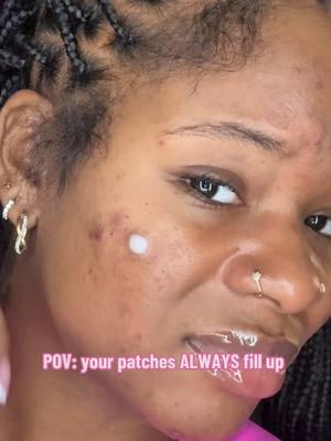 Come back for the reveal 🫶🏾 #acnejourney #fy #pimplepatchremoval 