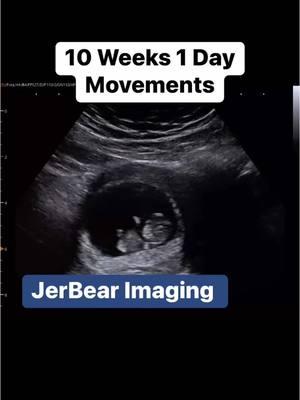 10 Weeks 1 Day Busy Baby  #jerbearimaging #ultrasoundnearme #10weekspregnant #busybaby #firsttrimester #wiggle #peaceofmind #comanchetx #brownwoodtx #visitbrownwood #imagingcenter #fyp www.jerbearimaging.com