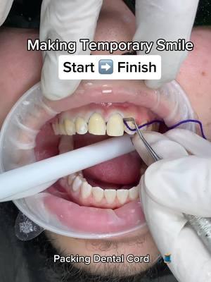 Start➡️Finish: Temporary smile 🥶💎 . . #porcelainveeneers #temporarysmile #veneerprocess #veneers #veneerslosangeles #smiledesign #dentalveneers #customsmile #smiledesigndentistry #minimalprepveneers