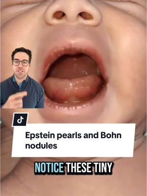 What are epstein pearls and bone nodules #epsteinpearls #bonenodules #baby #babymouth #babyteeth #newborn #newbornbaby #pediatrician #doctoryoshi 