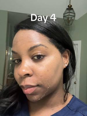 Cosmelan Peel day 3/4 #blackesthetician #chemicalpeelresults #chemicalpeel #skin 