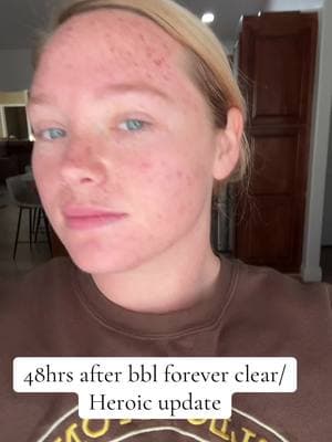 Some freckle’s and skin damage has come to the surface and is now starting to scab off. A lot has already come off. #bblheroic #bblforeverclear #facial #skindamage #acne 