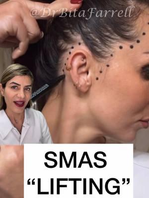 Don’t believe the hype… #smasbotox #smas #botox #botoxtraining #drbitafarrell #naturalaestheticscenter 