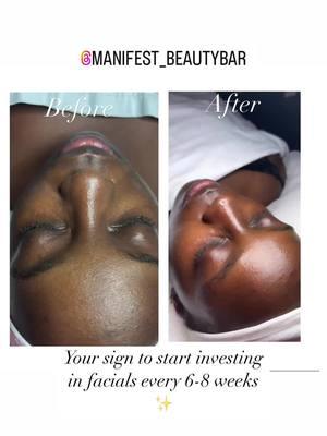 Before and after of my beautiful client . Her skin is doing incredibly well ✨#beforeandafter #manifestbeautybar #deepcleaning #oilyskin #combination #godsbusiness 