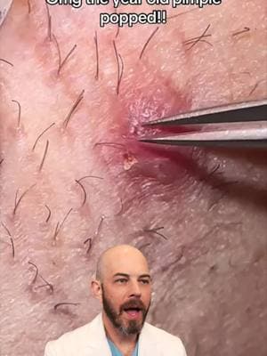 Pulling out multiple ingrown hairs from the year old pimple!  (credit: @delarouxskincare) satisfying #trending #ingrown