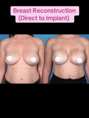 This patient had a direct to implant breast reconstruction with cc 485 cc F profile implants.  She had fat grafting as a second surgery. *this patient was kind enough to share her photos and story, she is not asking for your opinion about her body, be respectful in your comments #plasticsurgerybeforeandafter #beforeandafter #breastcancer #brca #breastreconstruction 