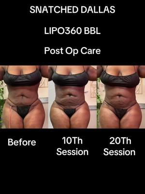 #lymphaticdrainagemassage #dallas #snatcheddallas #dallaspostopcare #dallasmassagetherapist #dallasnurse #dallasbodycontouring #dallasentrepreneur #foryou #lipo #lipo360 #lipo360andbbl #mommymakeover #fibrosis #cosmeticsugery #lymphaticmassagedallas #woundcare #dallasbodysculpting #necrosisremoval #seroma 