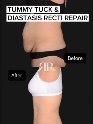 "I'm loving being pain free and feel so much more confident not looking pregnant anymore!" 😍🙌🏻 Diastasis Recti isn’t just a vanity issue—it's a functional one. A weakened core puts strain on your lower back, causing pain. Post-surgery, many patients feel relief, can work out without modifications, and regain their confidence! Have questions? Drop them below ⬇️  #DiastasisRecti #CoreStrength #LowerBackPain #PostSurgery #FitnessJourney #fyp #trending #beforeandafter #HealthAndWellness #MomLife #AbHealing #BodyConfidence #PhysicalTherapy #CoreRecovery #TransformationStory #viral #transformation #mommymakeover #WellnessTips #HealthyLiving #FeelGoodMovement