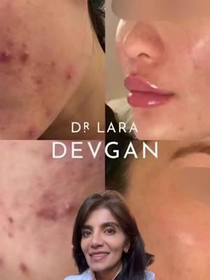 The power of medical grade skincare @Dr. Devgan Scientific Beauty #realclientstories #facialoptimization #plasticsurgery #plasticsurgeon #beautyisinthedetails 