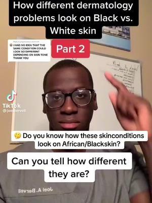 🤔 Do you know how these #skinconditions look on African/#Blackskin? Check out the #facts in this #Tiktok. Credit: @joelbervell #medical #medicalawarness #health #medicalfacts #dermatology#representationmatters #skincare #medical   #knowthesigns #Blackskin #themoreyouknow  #Worldfacts #Blackgirlfollowtrain #Blackmanfollowtrain #Blackmenfollowtrain  #Blacktiktokcommunity #Africantiktok #Africantiktokcommunity #Africantiktokinterntional