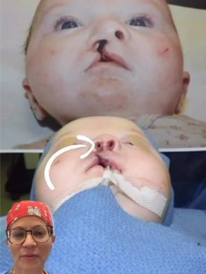 Hi 👋🏼 everyone! Today, I want to discuss the cleft nose. Specifically, the nasal 👃🏼 deformity associated with a unilateral cleft lip as well as the focus of the reconstruction. A typical unilateral cleft nasal deformity involves a deviated septum AND a malpositioned alar base.  Both of these anatomic abnormalities are addressed at the time of  the primary cleft lip repair 👍🏼. It is important to follow these kids until their craniofacial growth is complete in order to address any asymmetries or other changes that happen over the years. ⏰  Goal: To help make children WITH clefts look like children WITHOUT clefts. 😄 Mission: Transforming children’s lives one smile at a time. 👍🏼 These images are the property of Dr. Rachel A. Ruotolo and NYPSG and are not authorized for use by any other party. This is my actual patient with real results who has given informed consent (directly or indirectly via parents) to appear on my website and social media pages. #cleftlip #cleft #cleftnose #cleftbaby #nose #cleftliprepair #cleftrhinoplasty