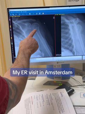 Replying to @Agnes only from my ER visit! I guess no playing football for me…😭😂 #brokenarm #ERvisit #amsterdamhospital 