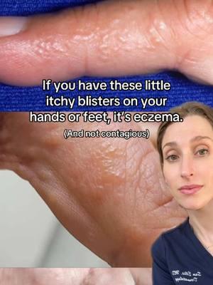 Struggling with itchy, tiny blisters on your hands or feet? It might be dyshidrotic eczema! 🖐👣 Common triggers include stress, allergies, sweat, or irritants like soaps. Treat it with gentle moisturizers, cool compresses, and avoid harsh products. Severe cases? See a dermatologist for tailored care — we may recommend prescription anti-inflammatory, phototherapy, and patch testing (to look for any allergy triggers!) #eczema #fyp #eczemaawareness #dyshidroticeczema #itchyblisters #handdermatitis 