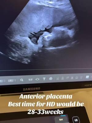 Would still recommend that you drink 40-62 ounces of water every day to increase amniotic fluid. We are still able to get cute pictures of baby at times. Placenta will be visible in the images 👶🏻🩷 #ultrasound #ultrasoundtech #pregnancy #anteriorplacenta #pregnancyannouncement #baby #pregnant #hdultrasound 