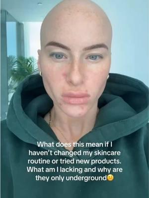 #stitch @chloe bean it’s a one step change in your routine that can make all the difference 🥰 #acneproneskin #acnebreakouts #skincareproductsmusthave #skincarerecommendations #skincaretips 