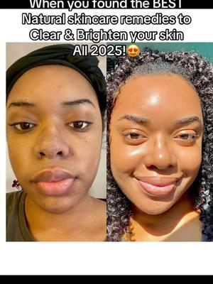 The BEST Natural remedies for Clear Glowing Skin all 2025!😍 #naturalskincare #naturalskincarethatworks #naturalskincareroutine #skincaretiktok #fyp #foryoupage #turmericsoap #turmericsoapbar #turmericsoapsoapfordarkspots #africanblacksoap #africanblacksoapresults #smallskincarebusiness #naturalskincarebusiness #organicskincare🌱 #whippedwonderlandskincare 